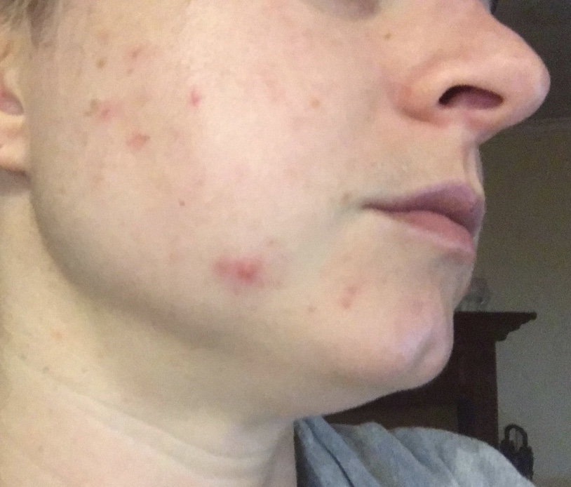 why does dairy cause acne reddit