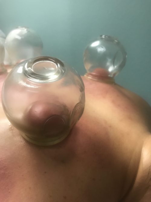 cupping therapy on back
