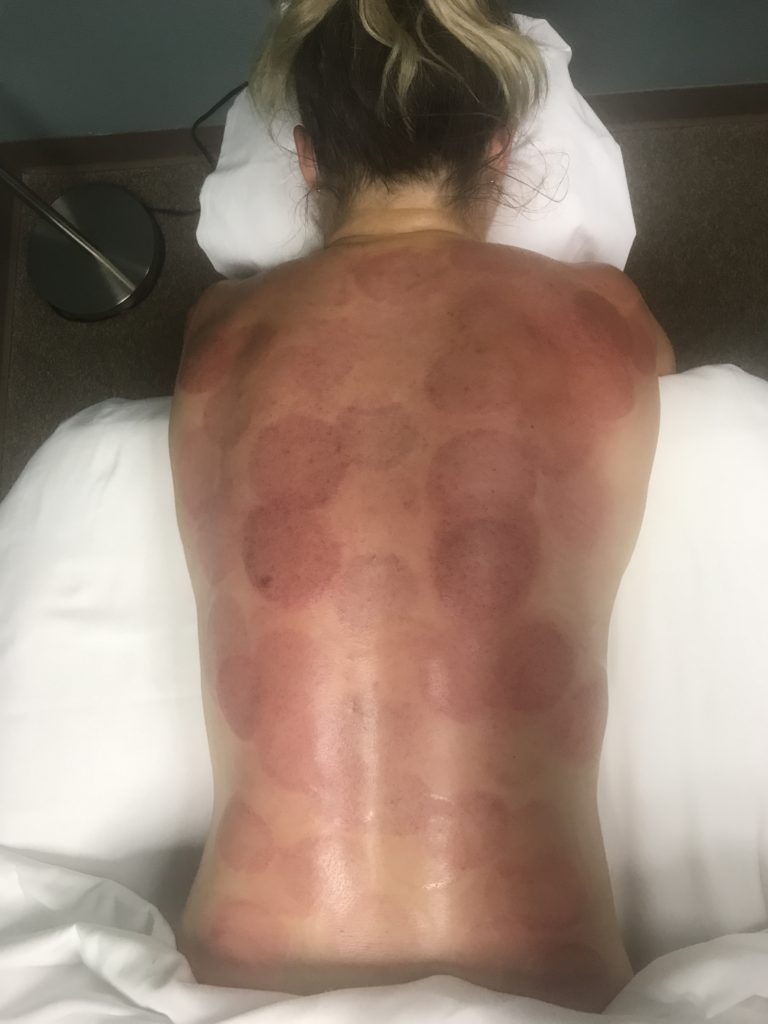 How Does Cupping Therapy Really Feel And How Does It Aid ...