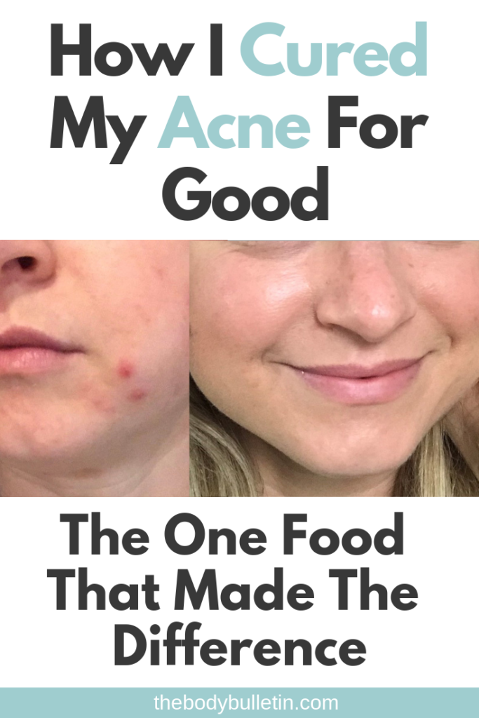 I've been plagued with acne my entire life  Dairy was a staple in my diet, I gave it up for clear skin but forgot one thing that made all the difference...  