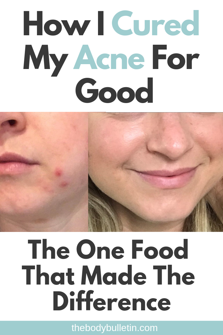 Is Dairy The Cause Of Acne? Here's My Before and After Proof • The Body