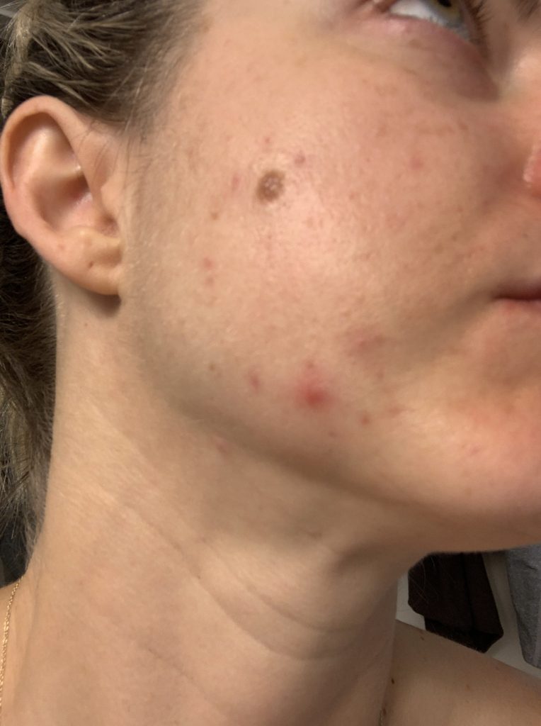 I tried acne patches (acne dots) for overnight spot treatment, in the post I detail what happened, how it works, and what doesn't work.  The hydrocolloid acne patch is the latest in overnight acne treatment